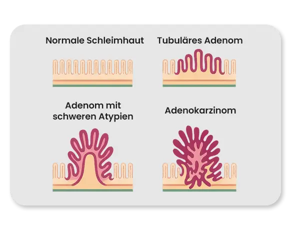 Ablauf der Adenom-Karzinom-Sequenz